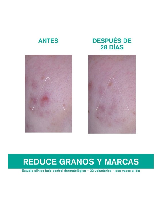 Crema Facial Cuidado Global Para Granos Hyseac 40 ml Uriage