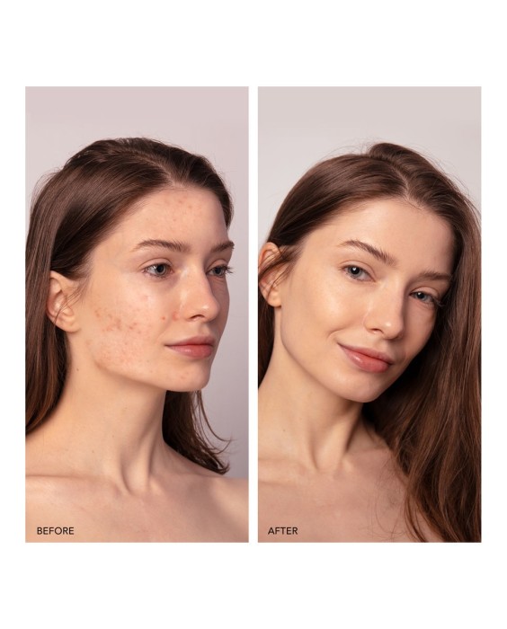 ESPADA™ 2 plus Dispositivo de tratamiento para el acné Pistachio FOREO