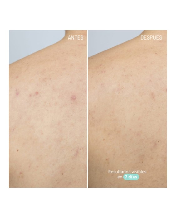 Gel Azelaic Active Body Treatment 100 ml Freshly Cosmetics