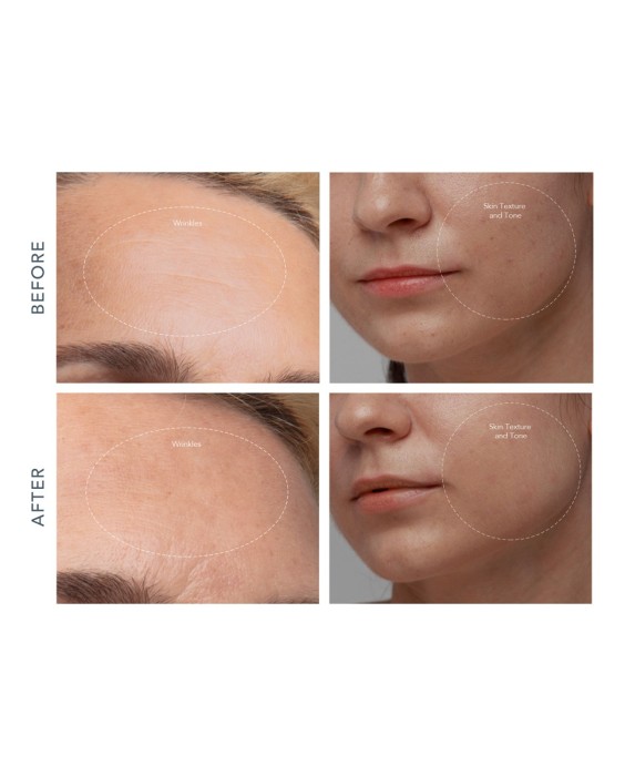 KIWI™ derma - Microdermoabrasión con diamantes Adamas y  dispositivo de aspiración de poros FOREO