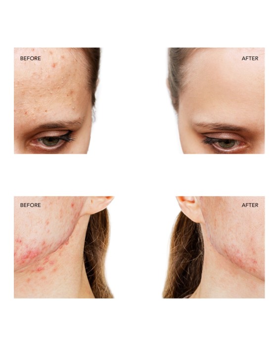 ESPADA™ 2 Dispositivo de tratamiento para el acné Fuchsia FOREO